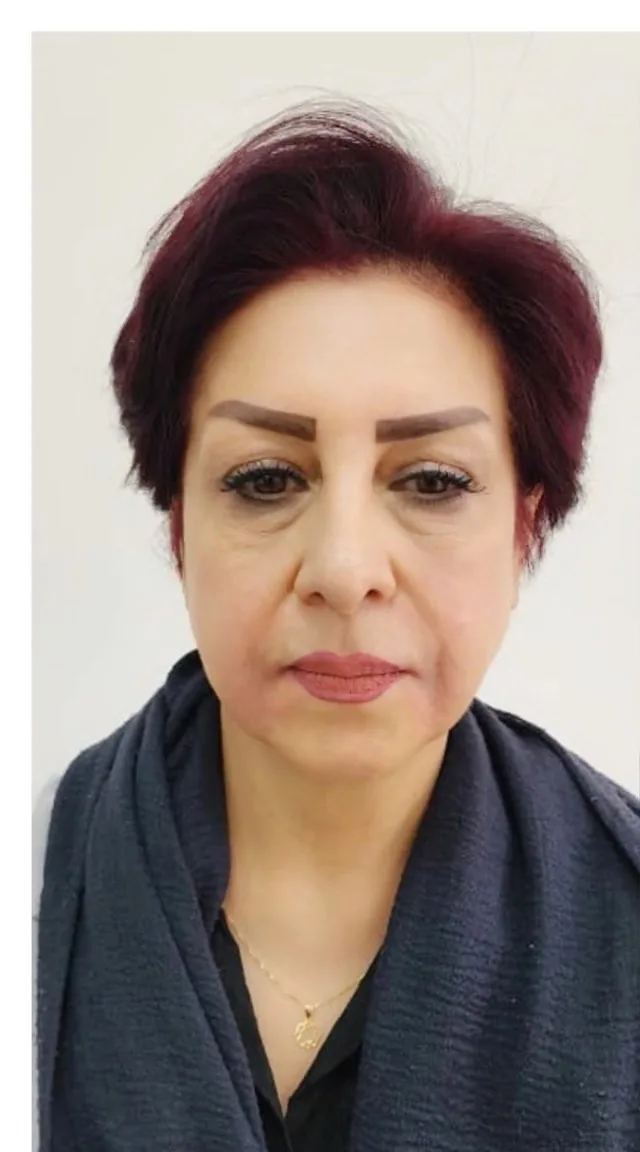 بعد از فیلر خط لبخند