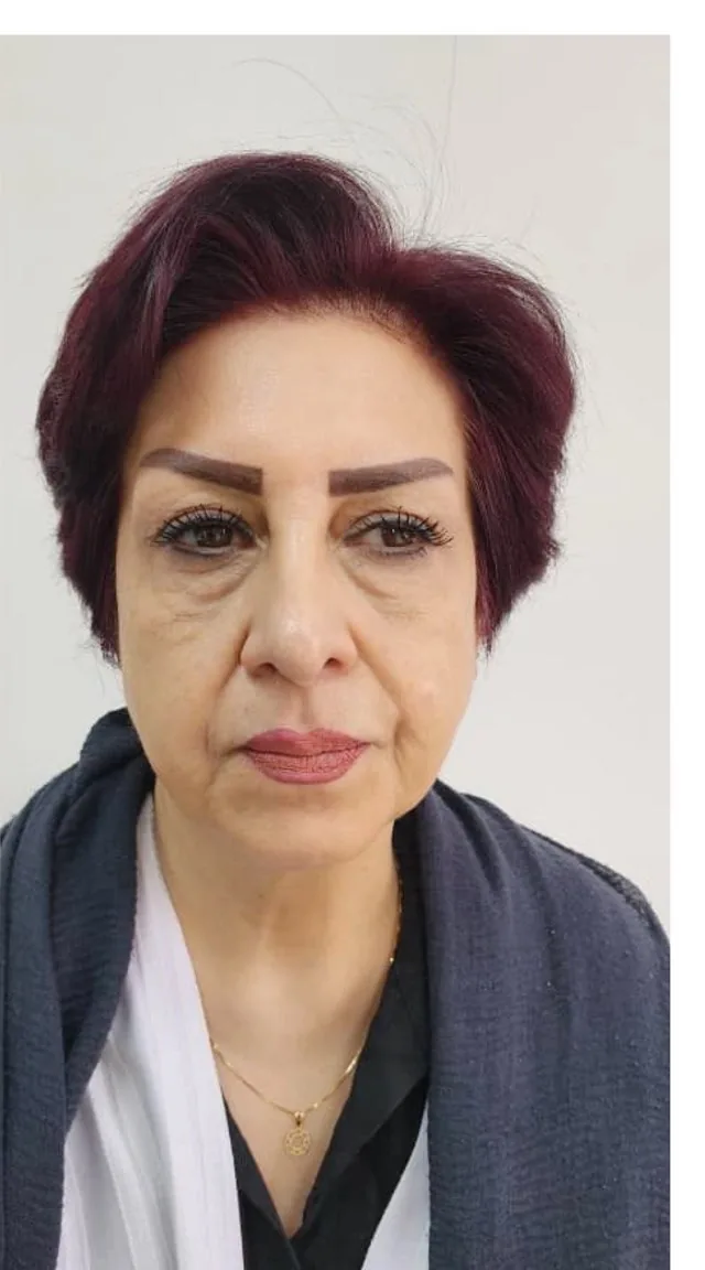 قبل از فیلر خط لبخند