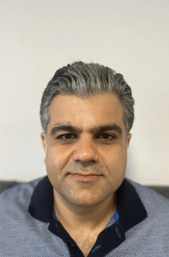 قبل از فیلر خط لبخند ۲